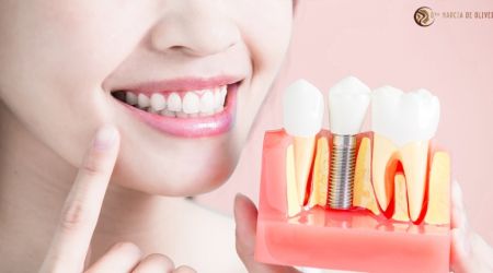 Mitos sobre Implantes Dentários