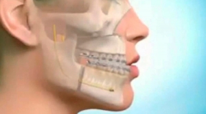 Prognatismo mandibular