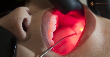 O que é a Laserterapia na Odontologia