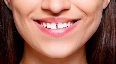 Diastema: O que é e como tratar?