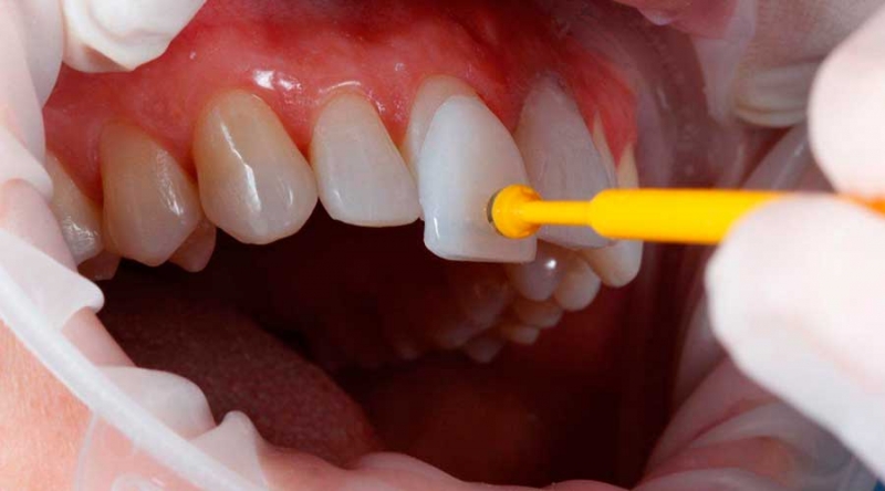 Qual a Diferença entre Faceta em Porcelana e Lente de Contato Dental?